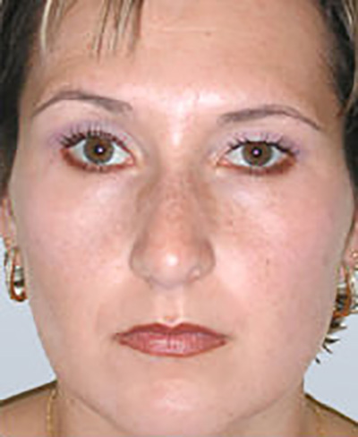rhinoplasty-surgery-nose-job-los-beverly-hills-after-front-dr-maan-kattash2