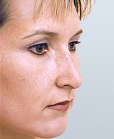 rhinoplasty-surgery-nose-job-los-beverly-hills-after-oblique-dr-maan-kattash2