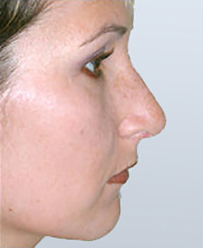 rhinoplasty-surgery-nose-job-los-beverly-hills-after-side-dr-maan-kattash2