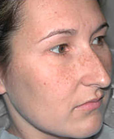 rhinoplasty-surgery-nose-job-los-beverly-hills-before-oblique-dr-maan-kattash2