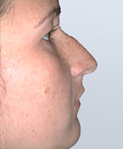 rhinoplasty-surgery-nose-job-los-beverly-hills-before-side-dr-maan-kattash2