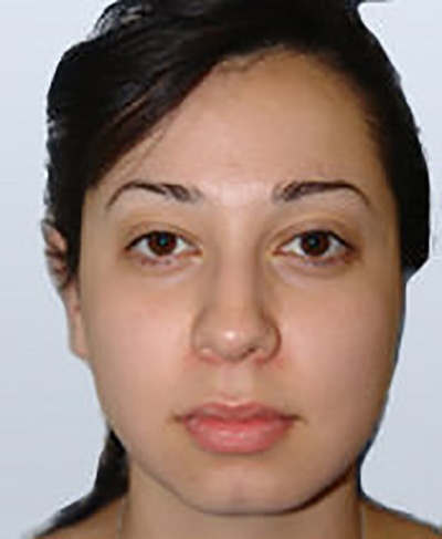 rhinoplasty-surgery-nose-job-los-upland-before-front-dr-maan-kattash2