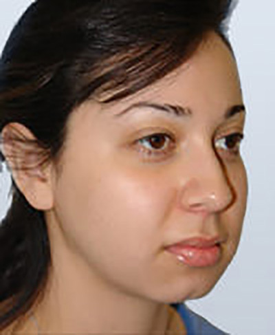 rhinoplasty-surgery-nose-job-los-upland-before-side-dr-maan-kattash2