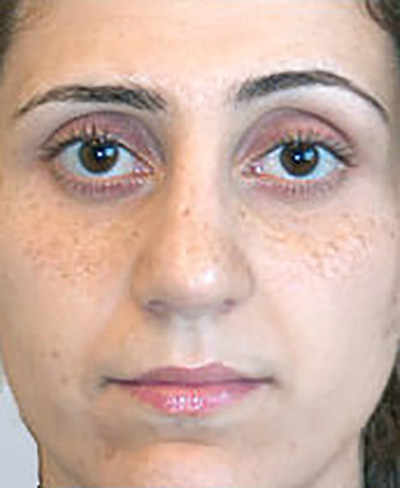 rhinoplasty-surgery-nose-job-tustin-woman-after-front-dr-maan-kattash2