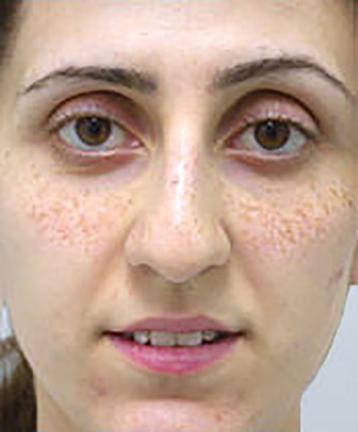 rhinoplasty-surgery-nose-job-tustin-woman-before-front-dr-maan-kattash2