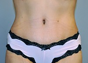 tummy-tuck-cosmetic-surgery-abdominoplasty-beverly-hills-woman-after-front-dr-maan-kattash