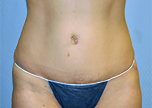 tummy-tuck-cosmetic-surgery-abdominoplasty-los-angeles-woman-after-front-dr-maan-kattash