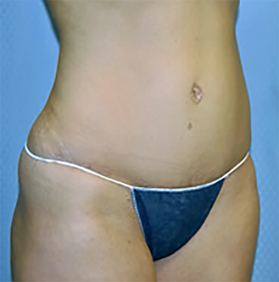 tummy-tuck-cosmetic-surgery-abdominoplasty-los-angeles-woman-after-oblique-dr-maan-kattash