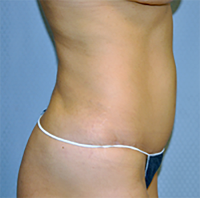 tummy-tuck-cosmetic-surgery-abdominoplasty-los-angeles-woman-after-side-dr-maan-kattash