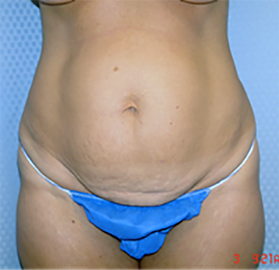 tummy-tuck-cosmetic-surgery-abdominoplasty-los-angeles-woman-before-front-dr-maan-kattash