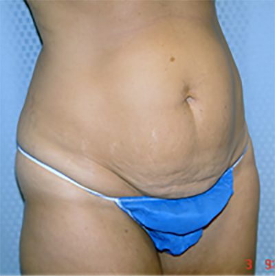 tummy-tuck-cosmetic-surgery-abdominoplasty-los-angeles-woman-before-oblique-dr-maan-kattash
