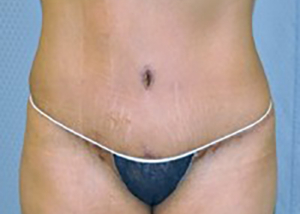 tummy-tuck-cosmetic-surgery-abdominoplasty-rancho-cucamonga-woman-after-front-dr-maan-kattash