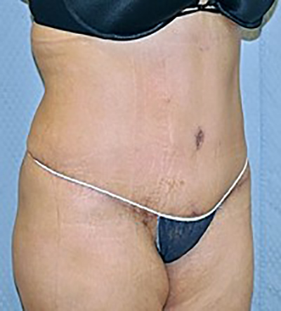 tummy-tuck-cosmetic-surgery-abdominoplasty-rancho-cucamonga-woman-after-oblique-dr-maan-kattash
