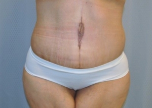 tummy-tuck-cosmetic-surgery-abdominoplasty-redlands-woman-after-front-dr-maan-kattash