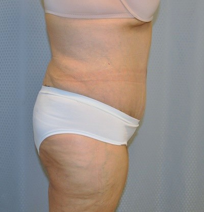 tummy-tuck-cosmetic-surgery-abdominoplasty-redlands-woman-after-side-dr-maan-kattash