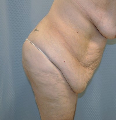 tummy-tuck-cosmetic-surgery-abdominoplasty-redlands-woman-before-bend-dr-maan-kattash