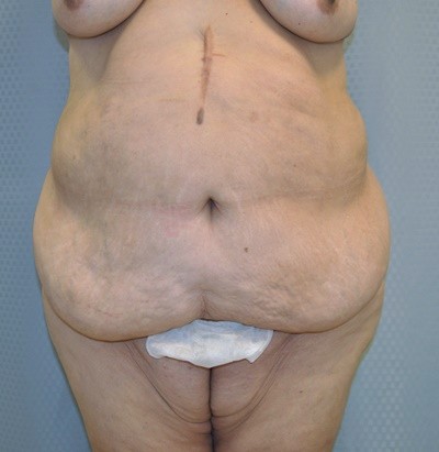tummy-tuck-cosmetic-surgery-abdominoplasty-redlands-woman-before-front-dr-maan-kattash