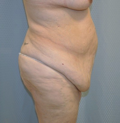 tummy-tuck-cosmetic-surgery-abdominoplasty-redlands-woman-before-side-dr-maan-kattash