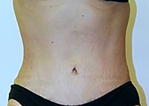 tummy-tuck-cosmetic-surgery-abdominoplasty-upland-woman-after-front-dr-maan-kattash