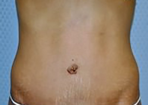tummy-tuck-plastic-surgery-abdominoplasty-loose-skin-claremont-after-front-dr-maan-kattash