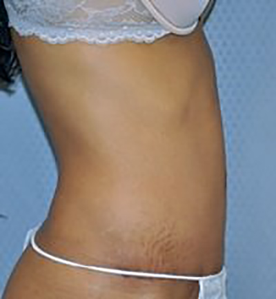 tummy-tuck-plastic-surgery-abdominoplasty-loose-skin-claremont-after-side-dr-maan-kattash