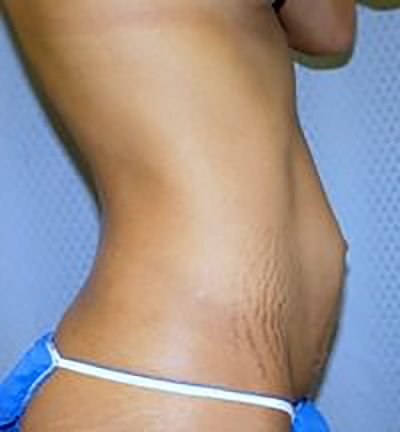 tummy-tuck-plastic-surgery-abdominoplasty-loose-skin-claremont-woman-before-side-dr-maan-kattash