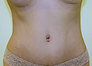tummy-tuck-plastic-surgery-abdominoplasty-loose-skin-orange-county-after-front-dr-maan-kattash