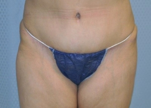 tummy-tuck-plastic-surgery-abdominoplasty-loose-skin-redlands-after-front-dr-maan-kattash