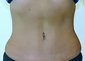 tummy-tuck-plastic-surgery-abdominoplasty-loose-skin-tustin-after-front-dr-maan-kattash