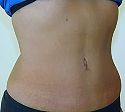tummy-tuck-plastic-surgery-abdominoplasty-loose-skin-tustin-after-oblique-dr-maan-kattash