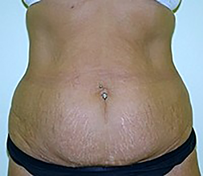 tummy-tuck-plastic-surgery-abdominoplasty-loose-skin-tustin-woman-before-front-dr-maan-kattash