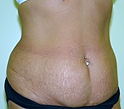 tummy-tuck-plastic-surgery-abdominoplasty-loose-skin-tustin-woman-before-oblique-dr-maan-kattash