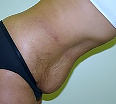 tummy-tuck-plastic-surgery-abdominoplasty-loose-skin-tustin-woman-before-side-dr-maan-kattash