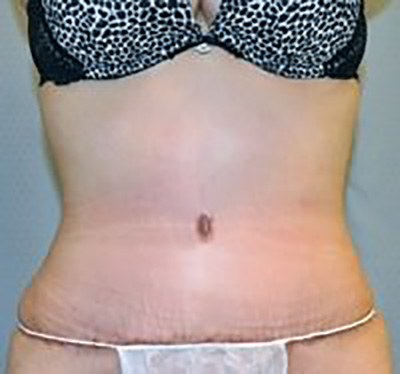 tummy-tuck-plastic-surgery-abdominoplasty-loose-skin-upland-after-front-dr-maan-kattash