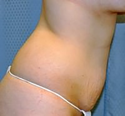 tummy-tuck-plastic-surgery-abdominoplasty-loose-skin-upland-woman-before-side-dr-maan-kattash